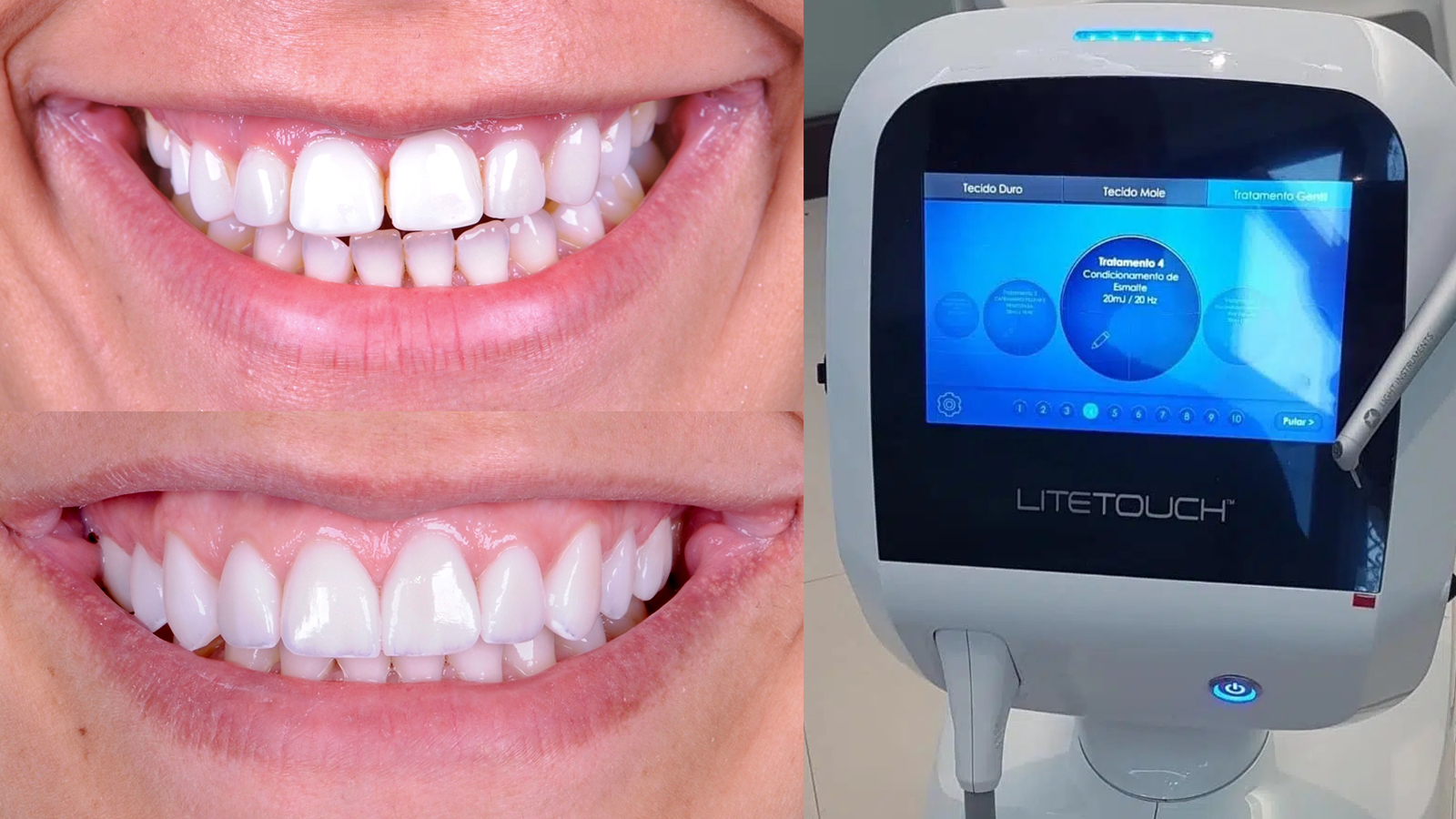 facetas de cerâmicas