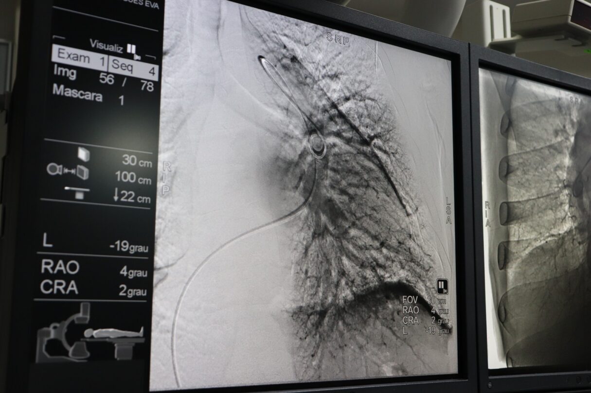 Médicos do HGG recebem capacitação para realizar angioplastia pulmonar por balão. Foto: SES-GO
