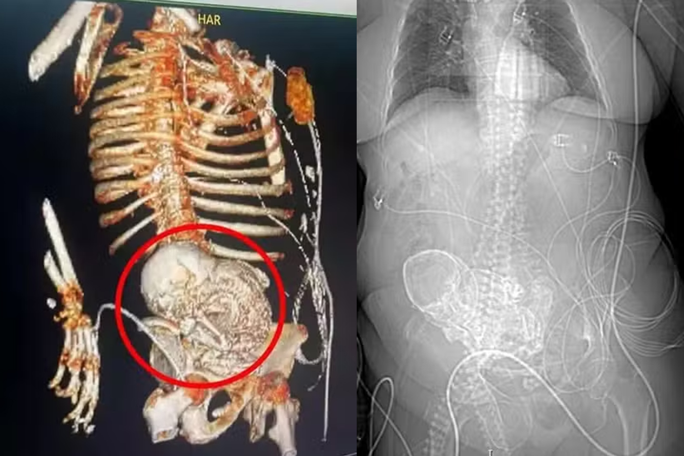 Litopedia feto calcificado gravidez idosa