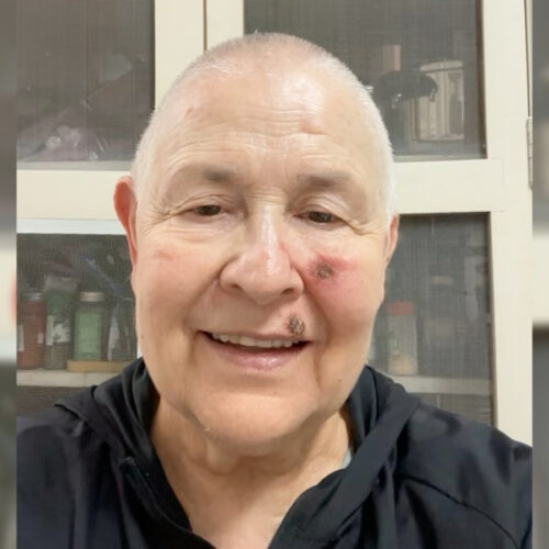 Monja Coen Cancer de Pele