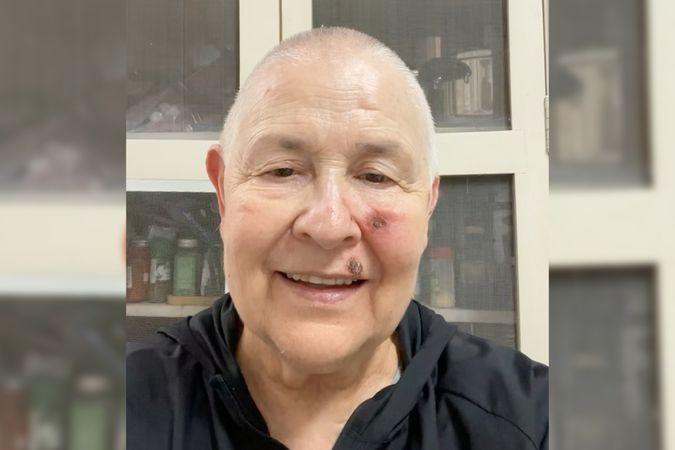 Monja Coen Cancer de Pele