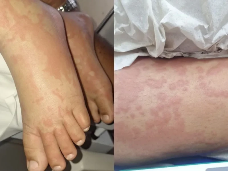 Reações na pele da criança foram após uso do detergente segundo família - Foto - arquivo pessoal reprodução CNN Brasil